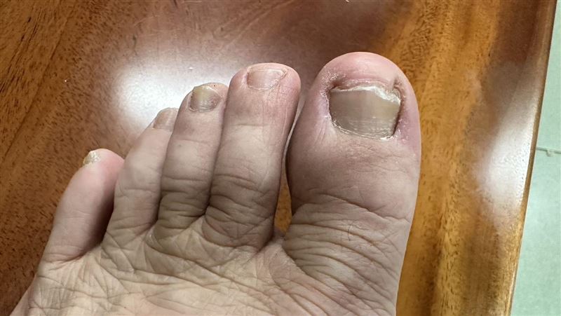 指甲亂剪害凍甲!醫揭正確剪法:不要太圓