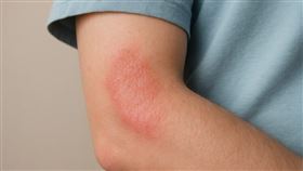 越焦慮越癢，越癢越焦慮？皮膚科醫師揭開「壓力」引發皮膚發炎隱形枷鎖。（圖／醫健新聞網提供） 