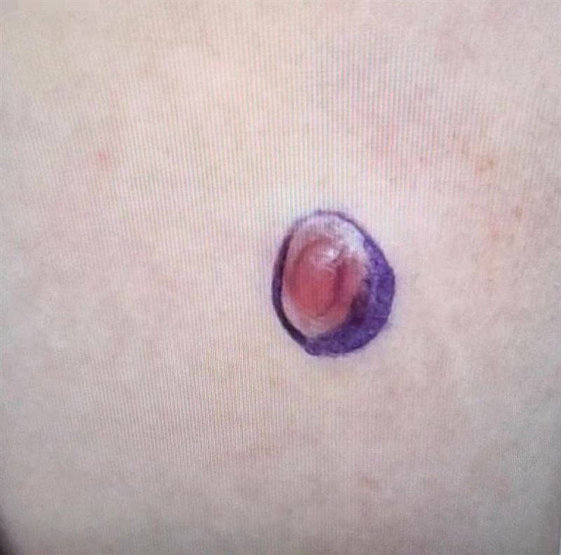 病人上腹部皮膚出現隆起硬塊(藍圈處)，檢查竟是罕見肉癌。（圖／大千綜合醫院提供）