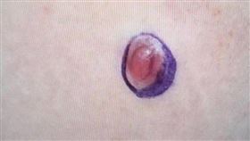 病人上腹部皮膚出現隆起硬塊(藍圈處)，檢查竟是罕見肉癌。（圖／大千綜合醫院提供） 