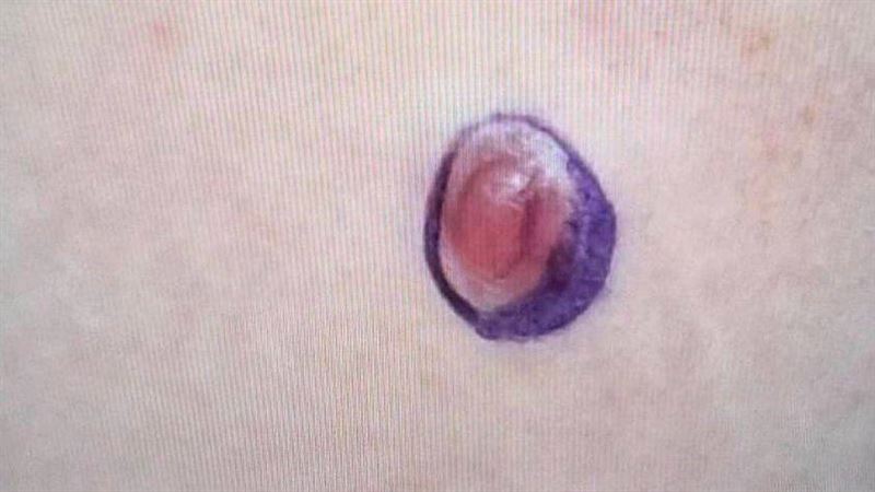 國中生腹部皮膚硬塊 檢查竟是罕見肉癌