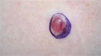 國中生腹部皮膚硬塊　檢查竟是罕見肉癌