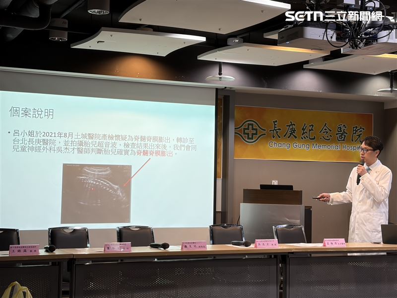 蕭勝文醫師說明「脊髓脊膜膨出」個案。（圖／記者簡浩正攝影）