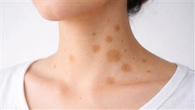 斑點。（圖／AI製圖）