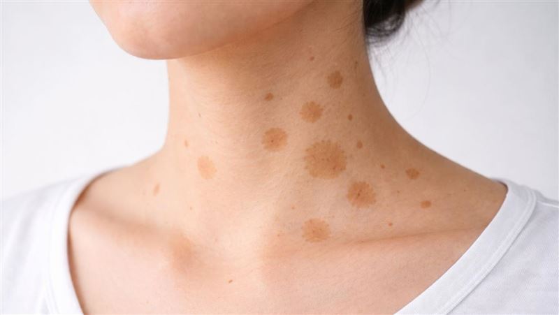不是胎記!冒出咖啡斑是警訊 超過6顆小心