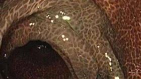 醫生在手術中發現，患者部分結腸已失去彈性，腸壁呈現異常黑色，甚至出現如豹紋般斑駁紋路。（圖／翻攝自微博）