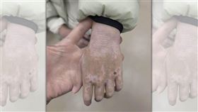 台大醫院皮膚科醫師烏惟新分享診間案例，呼籲家長切勿因恐懼類固醇而讓孩子錯過異位性皮膚炎的黃金治療期。（翻攝自臉書/皮膚專科 烏惟新醫師）