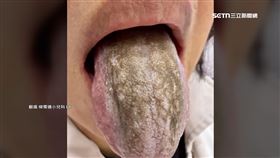 一天狂漱口6次想殺菌！婦舌頭慘變「黑森林」