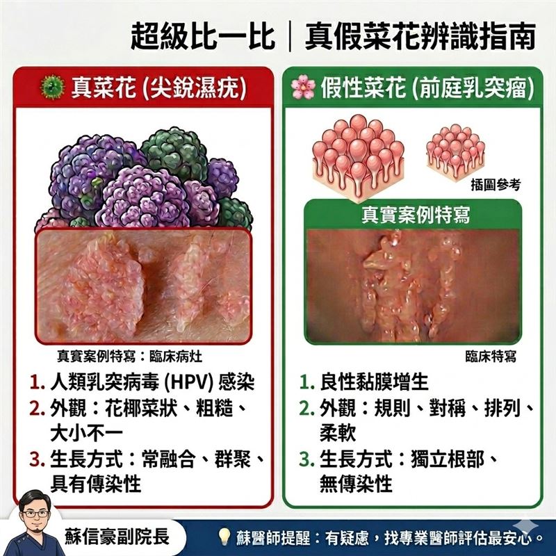 女「私密處長顆粒」哭求診，蘇信豪醫師揭「假性菜花」真相：不是性病啦。（圖／翻攝自泌尿科蘇信豪醫師 - 鳳山李嘉文泌尿科診所臉書）