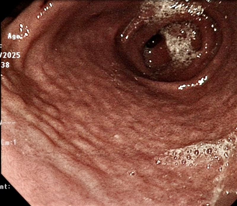 圖為胃鏡下典型的幽門螺旋桿菌感染胃黏膜表現。（圖／翻攝自肚肚醫師-洪華希 兒童腸胃科臉書）