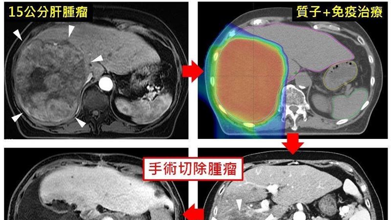 罹肝癌被判剩半年 15公分腫瘤竟變6公分