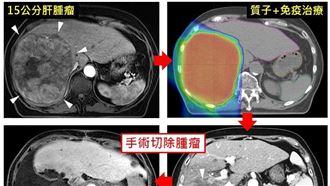 罹肝癌被判剩半年　15公分腫瘤竟變6公分