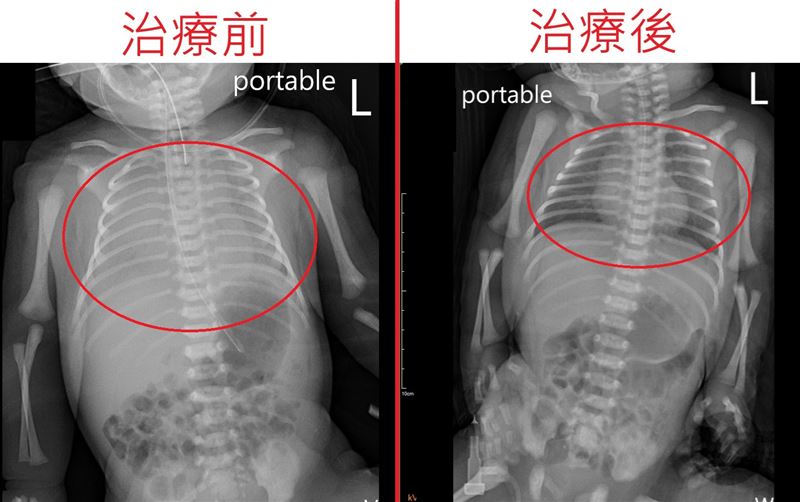 經過10天的新生兒治療照護,終於順利恢復正常呼吸,活力滿滿順利出院。(圖/烏日林新醫院提供)