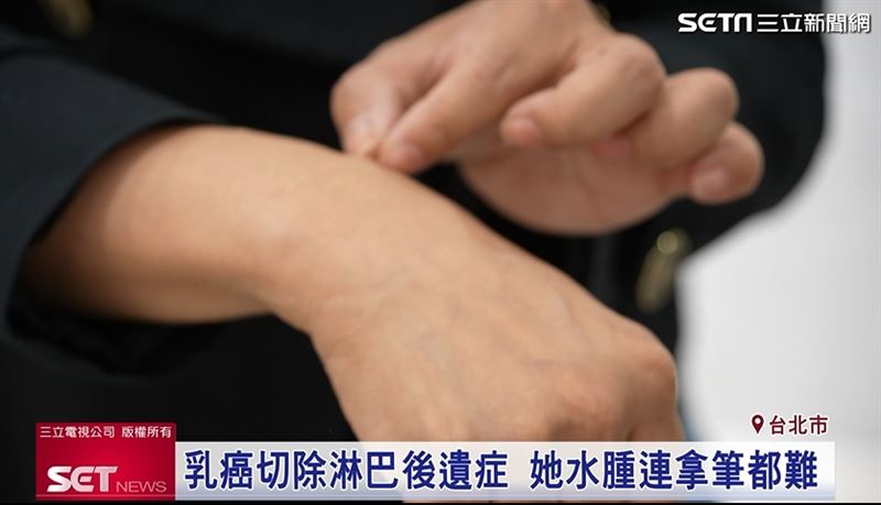 楊小姐當時拿筆寫字時右手莫名緊繃，經診斷確定淋巴水腫，動手術後現今恢復良好