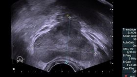 陳先生一年多前健康檢查時發現PSA數值過高而求診，沒想到後續竟罹攝護腺癌。（圖／書田診所提供）