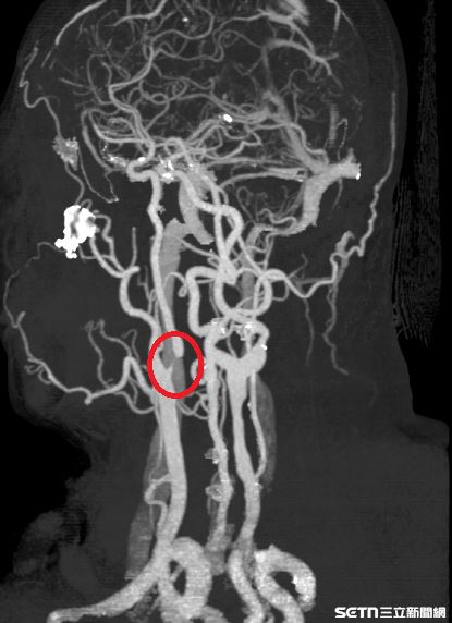 南投50歲的林先生，本身是高血脂患者，日前不時感到頭暈和左邊手腳發麻，到南投醫院檢查後，雖還未有明顯中風跡象，但醫師進一步安排頸動脈超音波檢查，結果發現內頸動脈已有狹窄的情形，連忙將他收治住院並轉介神經外科陳奕安醫師，進行內頸動脈血管成形術（氣球擴張合併支架置放）。（圖／南投醫院授權提供）
