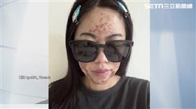 濃度40%誤拿70%　果酸換膚害女臉部近乎毀容