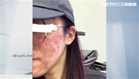 濃度40%誤拿70%　果酸換膚害女臉部近乎毀容