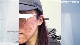高雄女果酸換膚毀容　查獲過期化粧品開罰