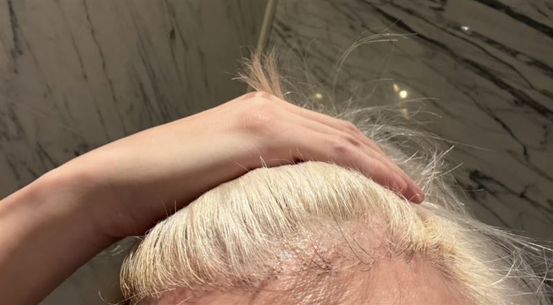 薛之謙頭皮長滿水泡。（圖／翻攝自小紅書）