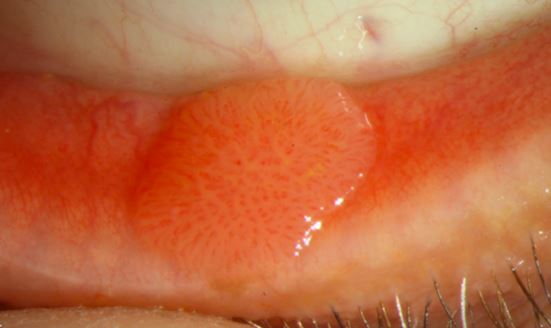 個案左下眼瞼的中央部分，也發現一塊長0.5公分的非典型菜花病灶。類似扁平丘疹，呈現出淡紅色，表面稍微粗糙，但沒有典型的絨毛突起。（圖／洪啟庭提供）