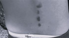  女童的傷勢。（圖／劉美芳辦公室提供）