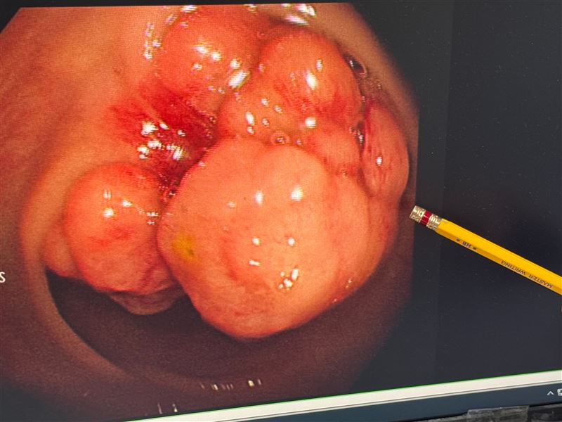 60多歲婦人在3個月內狂瘦10公斤，起初還以為是減肥成功，沒想到卻是罹患大腸癌3期。(圖／大甲李綜合醫院提供)