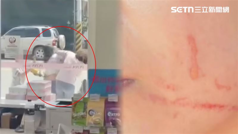 3寶媽vs婦…掌摑、肋骨血爪痕!導火線曝