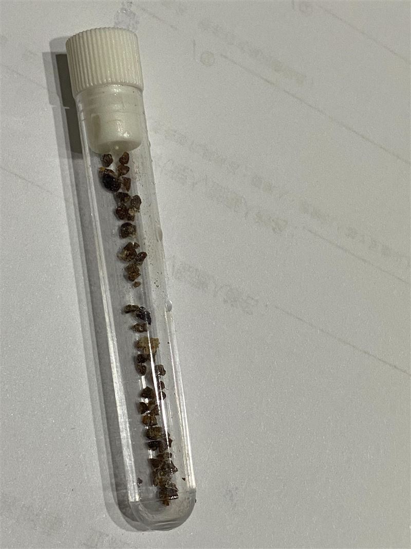 男子接受軟式輸尿管鏡逆行性腎臟內取石手術，處理約36顆結石。（圖／中國醫藥大學新竹附設醫院提供）