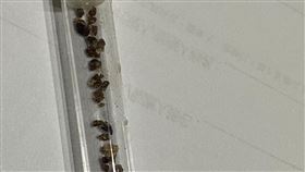 45歲男血尿又腰痛　「36顆腎結石」塞爆畫面曝（圖／中國醫藥大學新竹附設醫院提供）