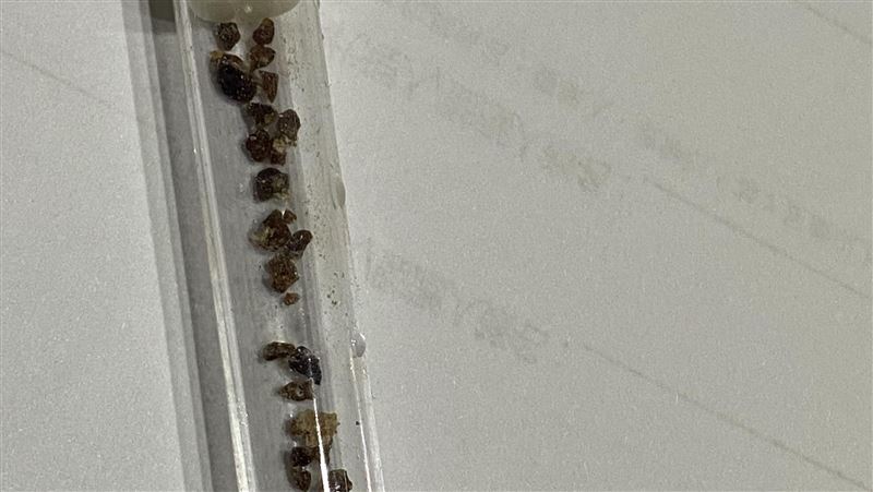 45歲男血尿又腰痛　36顆腎結石塞爆畫面曝