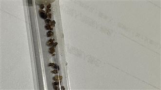 45歲男血尿又腰痛　36顆腎結石塞爆畫面曝