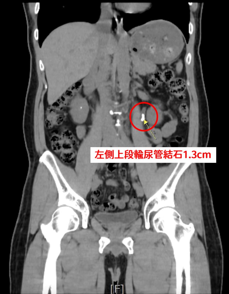 患者左側腎盂輸尿管交接處約有1.3公分結石。（圖／中國醫藥大學新竹附設醫院提供）