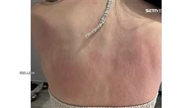 睡2晚「大過敏」女控有塵蹣　飯店「肉眼沒蟲」拒賠