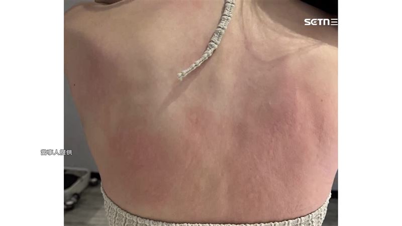 睡覺過敏女控有塵蹣 飯店:肉眼沒蟲拒賠