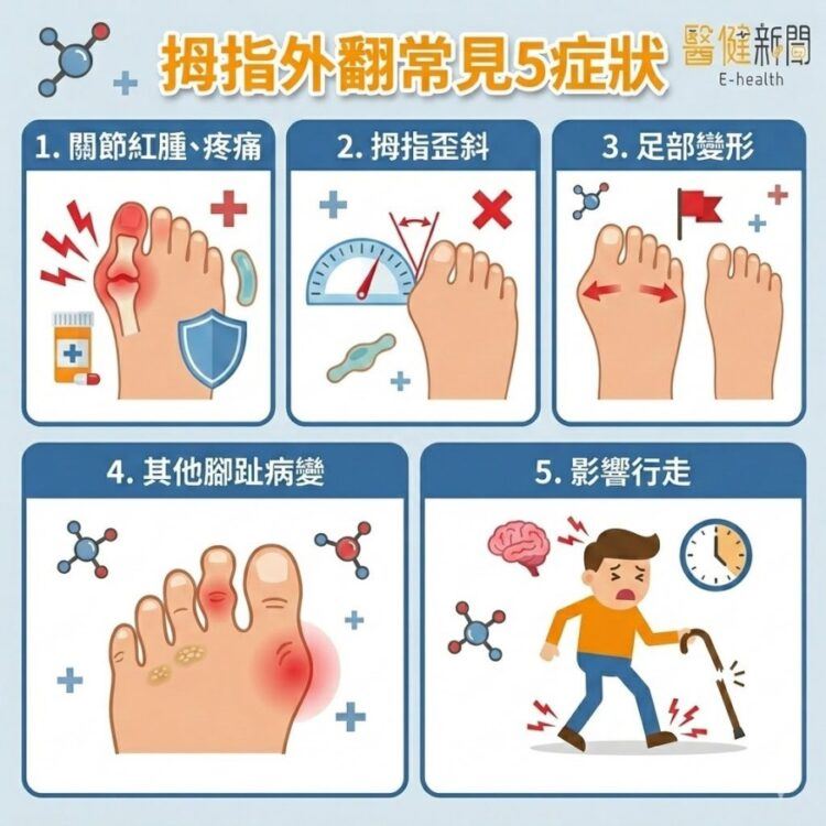 拇指外翻怎根治？關鍵在嚴重程度！常見「5症狀」！（圖／醫健新聞網提供）