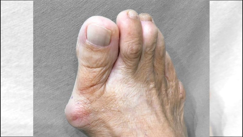 拇指外翻怎根治？關鍵在嚴重程度！常見「5症狀」、「2種」治療方式！（圖／醫健新聞網提供）