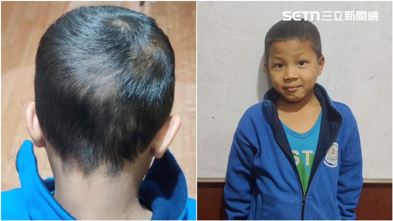 男孩經過治療後恢復健康。（圖／石睿航提供）