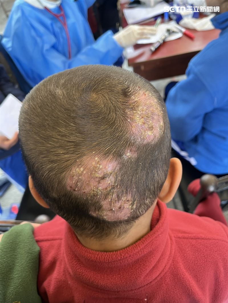 6歲的小男孩頭頂有部分已經禿掉，皮膚有嚴重感染、化膿。（圖／石睿航提供）
