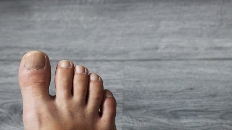 逆生性指甲是「凍甲」？與甲溝炎不同？皮膚科醫提4大成因、2大治療方式。（圖／醫健新聞網提供）