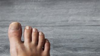 逆生性指甲！皮膚科醫提4大成因、2大治療