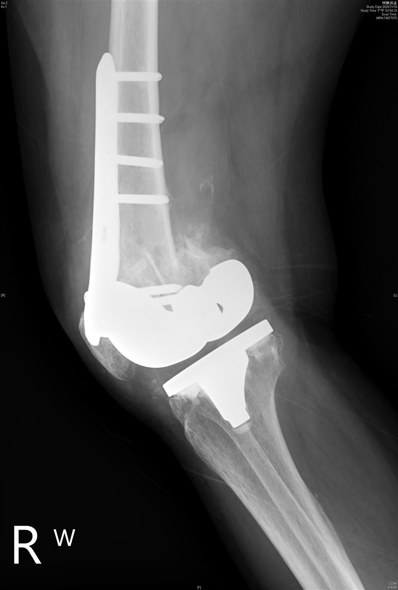 嚴重骨質疏鬆恐導致二度骨折。（圖／北市聯醫陽明院區提供）