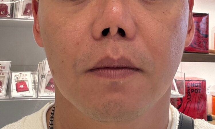 許英哲分享，曾有病患赴國外進行隆鼻手術，本來以為一切順利，沒想到術後發炎、取出植入物後鼻子竟然攣縮、變形，並且出現「容貌焦慮」卻求償無門。（圖／醫健新聞網提供）