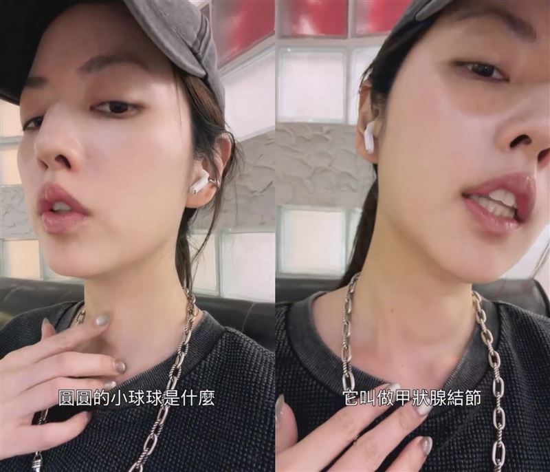 阿諾脖子長出良性腫瘤，將安排手術切除。（圖／翻攝自阿諾IG）