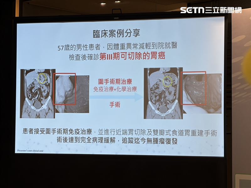 北榮教授方文良分享胃癌個案。（圖／記者簡浩正攝影）