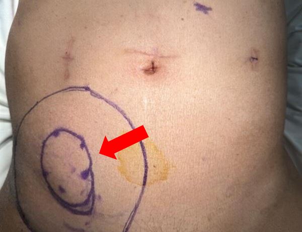 車禍手術後半年回診時，李先生腹部明顯隆起(紅色箭頭處)，形成直徑約20公分腹壁疝氣。（圖／亞東醫院提供）