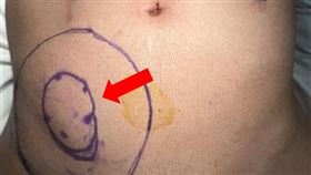 車禍手術後半年回診時，李先生腹部明顯隆起(紅色箭頭處)，形成直徑約20公分腹壁疝氣。（圖／亞東醫院提供）