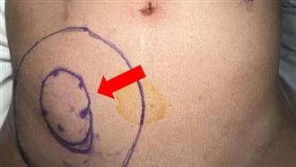 嚴重車禍撿回一命！7旬翁竟「腹壁崩塌」