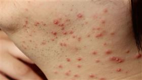 錯用類固醇藥膏，塗抹胸口濕疹，26歲女變紅豆胸嚇壞(圖／茂盛醫院提供)