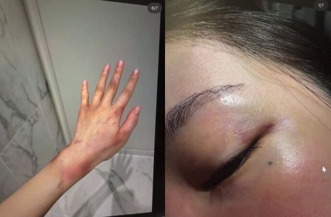 A女的友人爆料A女遭受Jisoo哥哥虐打的照片畫面。（組合圖／翻攝自theqoo）